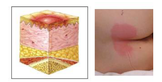 压疮最新分期及其临床意义解析